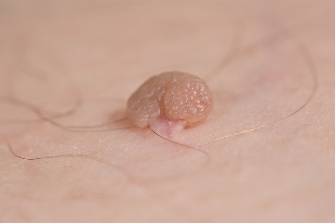 skin tag removal overnight