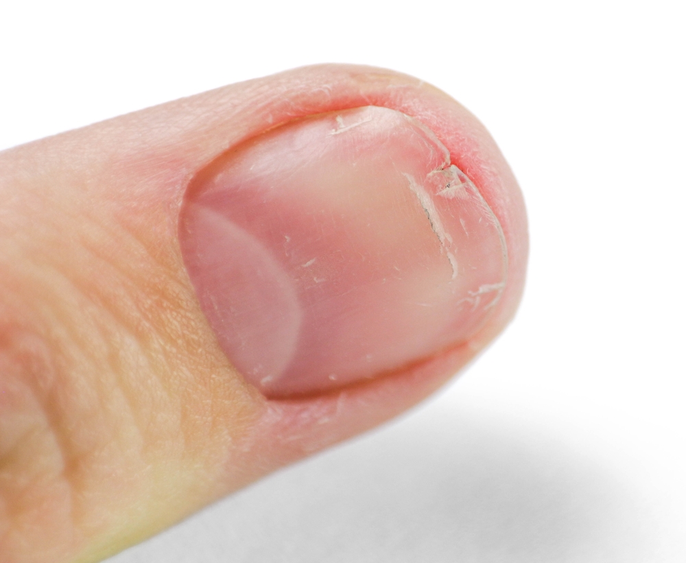 how to fix a vertical split nail