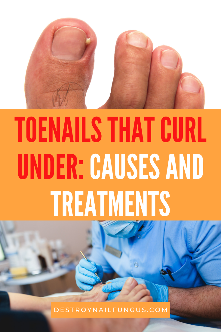 why do toenails curl under