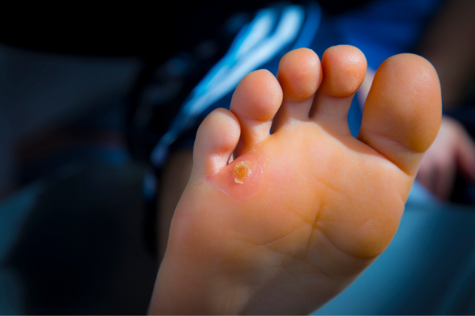 how to remove calluses from feet permanently