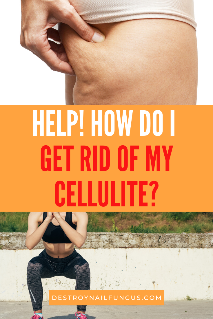 can you get rid of cellulite once you have it