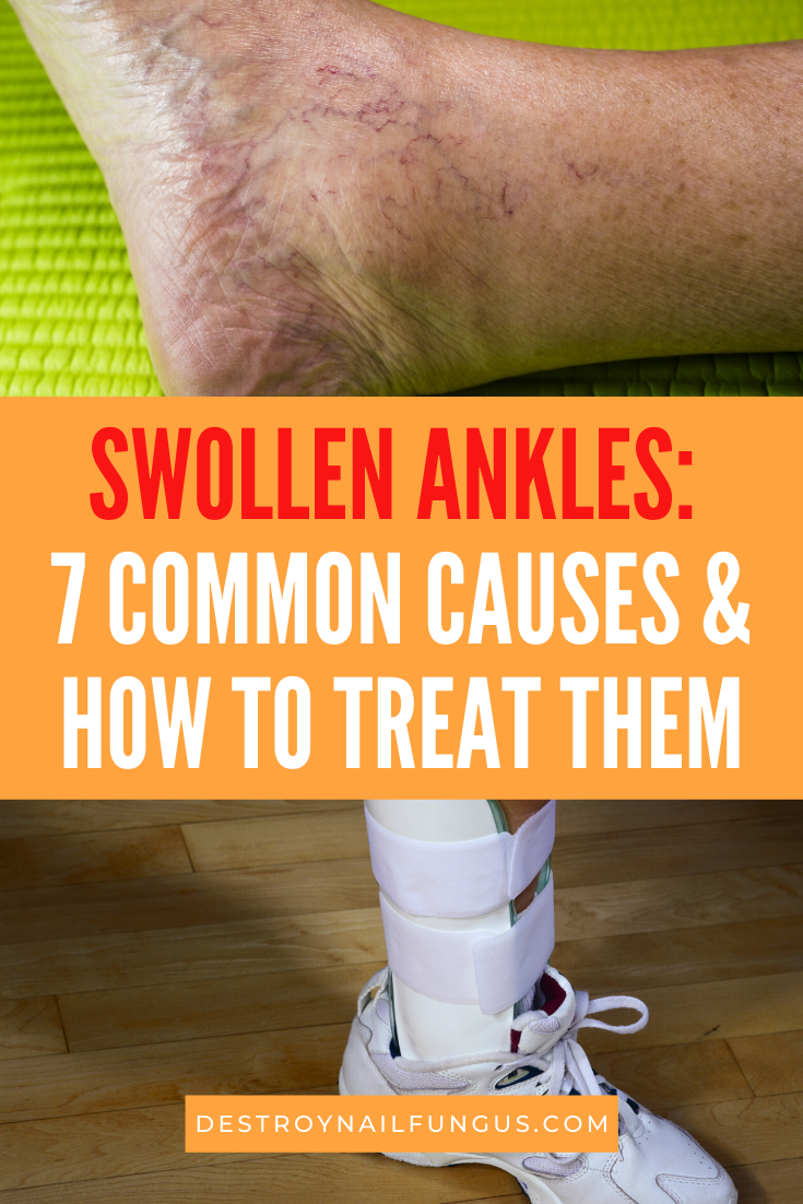 how to treat swollen ankles