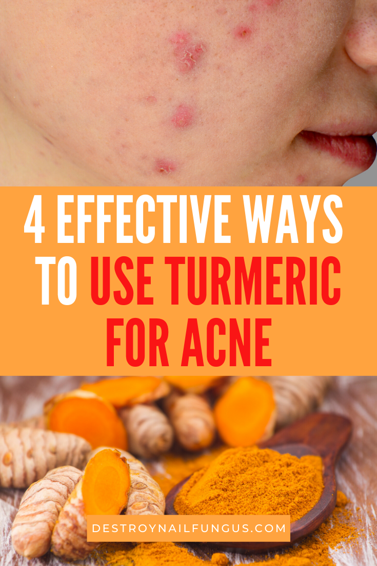 how to use turmeric for acne